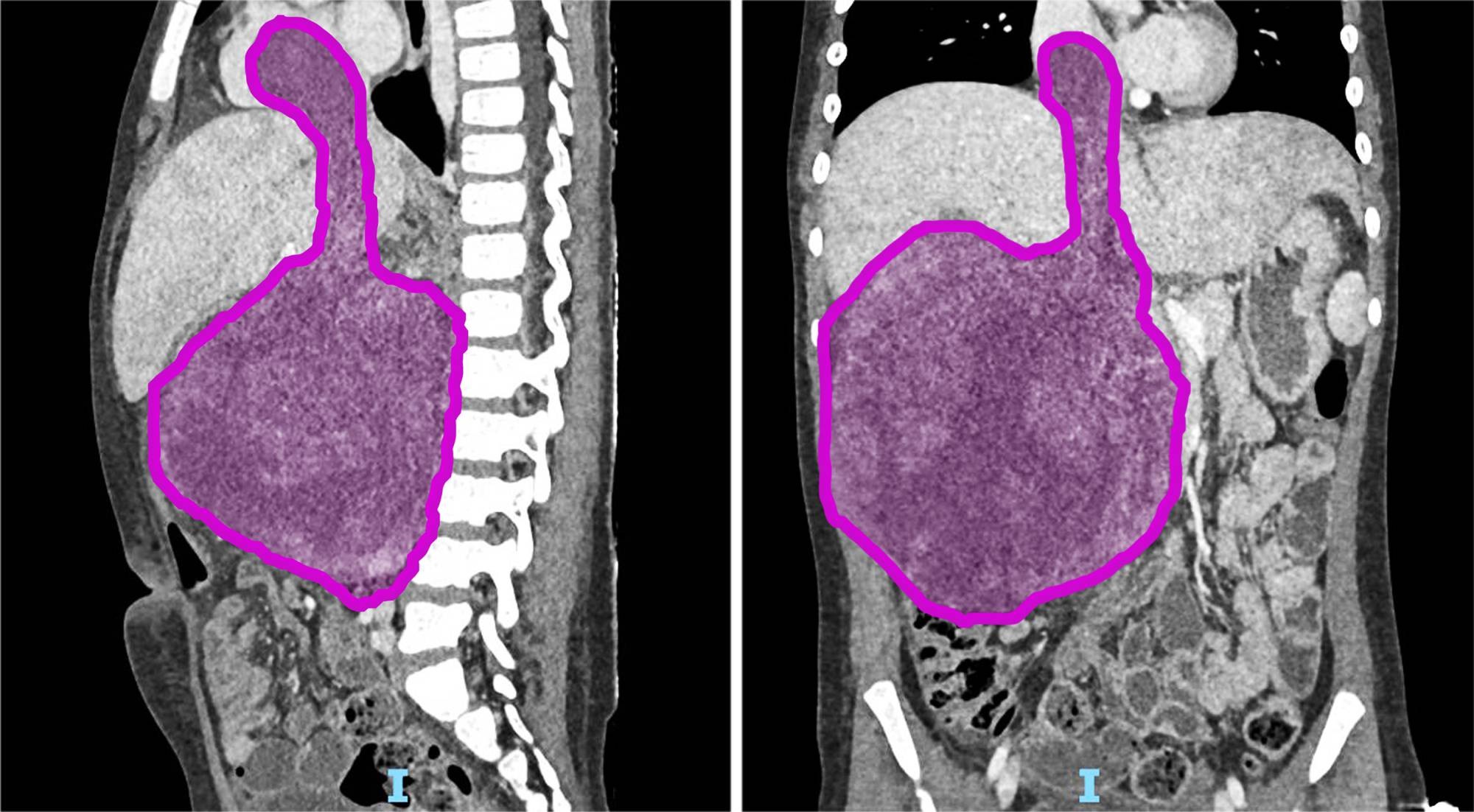 Nefroblastoma laterale e frontale