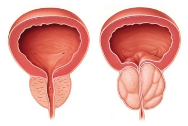 ipertrofia prostatica benigna